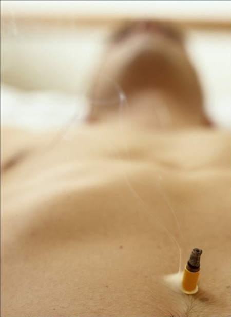 In the top photo, a patient is receiving moxibustion, a traditional medical practice that is proven to be helpful in relieving pain by burning small cones of dried herbs on certain designated points of the body. (Korea Times files)