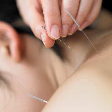 Acupuncture